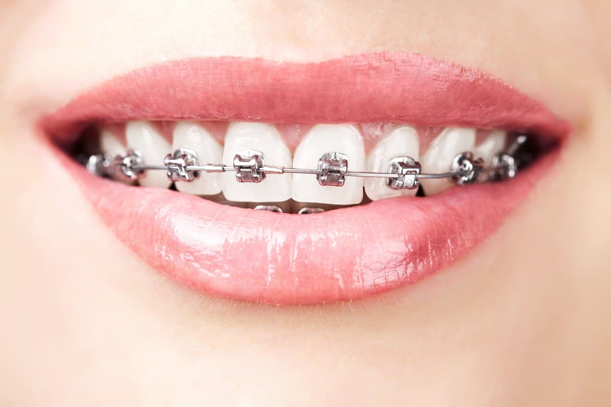 Orthodontic Treatment for TMJ Disorder Headache & TMJ Center of New